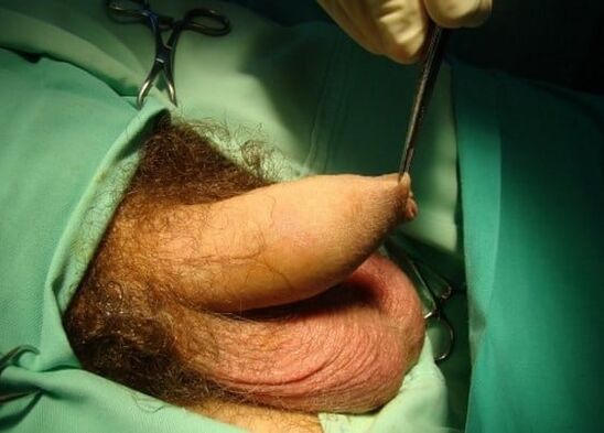 surgery for penis enlargement